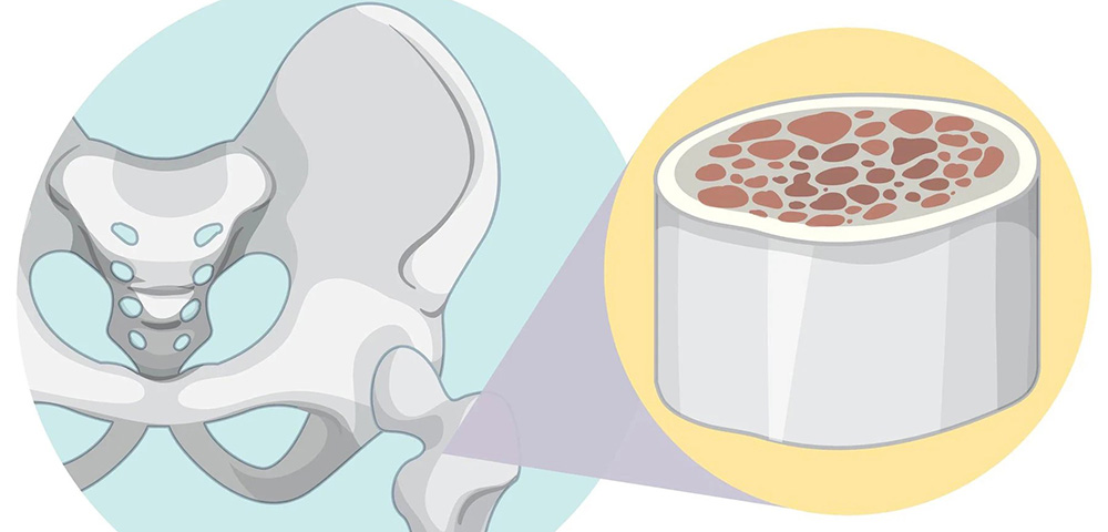 骨密度： 守护骨骼健康的“隐形盾牌”